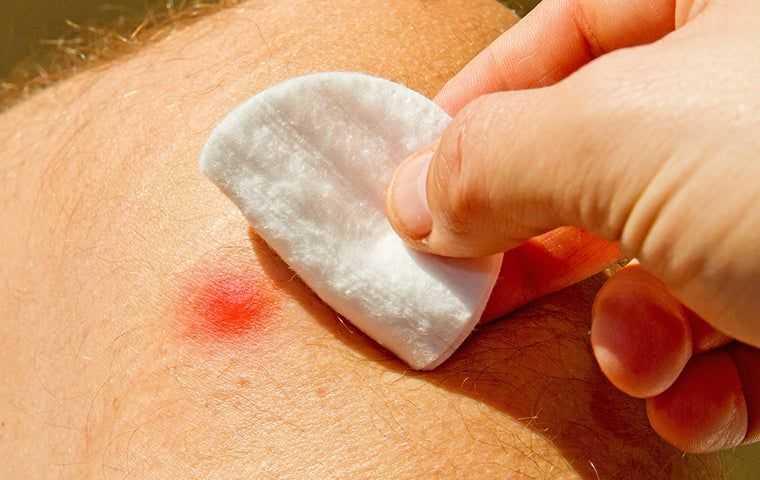 cotton pad over a bee sting